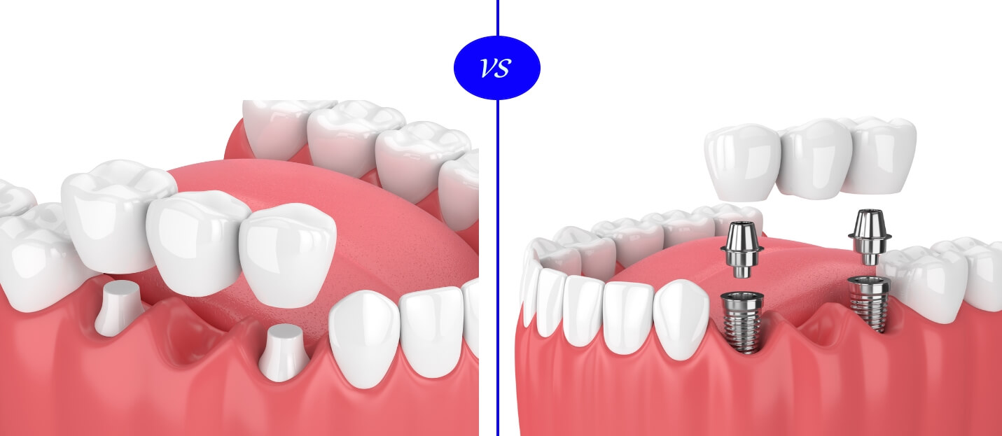 All-on-Fours vs. Dentures | Dental Practice in Cohoes, NY