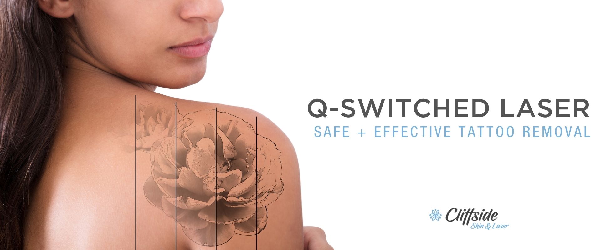 Q-Switched Laser: The Gold Standard for Tattoo Removal in 2016 - Cheap Deals for Laser Machines Available