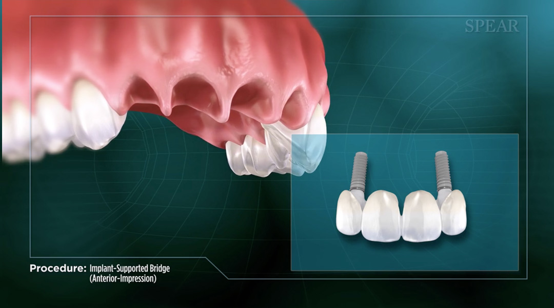 Dental Care Clinic Updates Regarding Implant-Supported Bridges - Benzinga