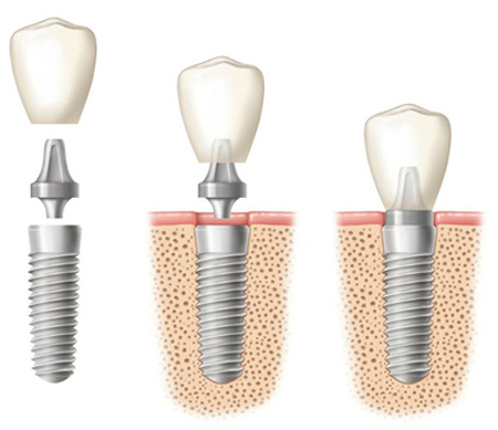 Zirconia Crowns in Solihull | One Dental & Implant Clinic, Dorridge