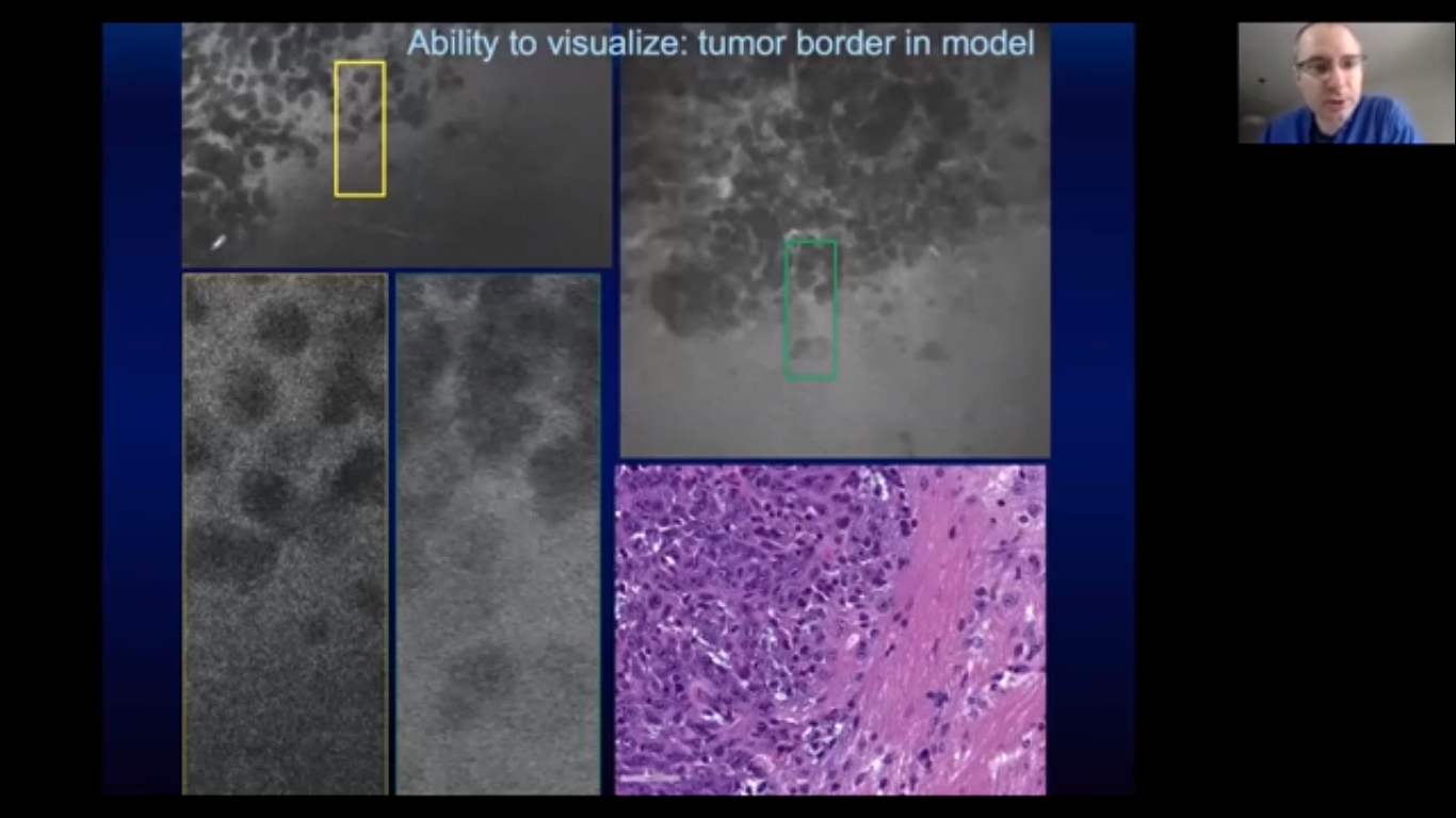 Poster 1066 Identifying a Mucinous Neoplasm Utilizing Confocal Laser Endomicroscopy: Branch-Duct Gastric Type Intraductal Papillary Mucinous Neoplasm - American College of Gastroenterology