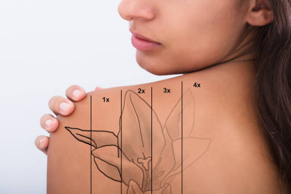 Laser Tattoo Removal Near Dallas | LaserAway