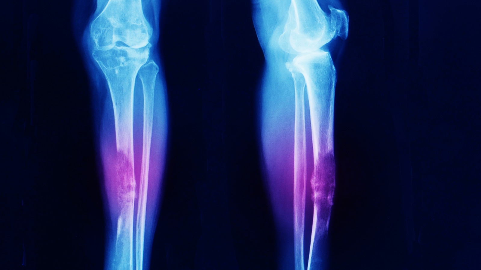 Traction for Fracture around a loose tibial component with poor bone stock