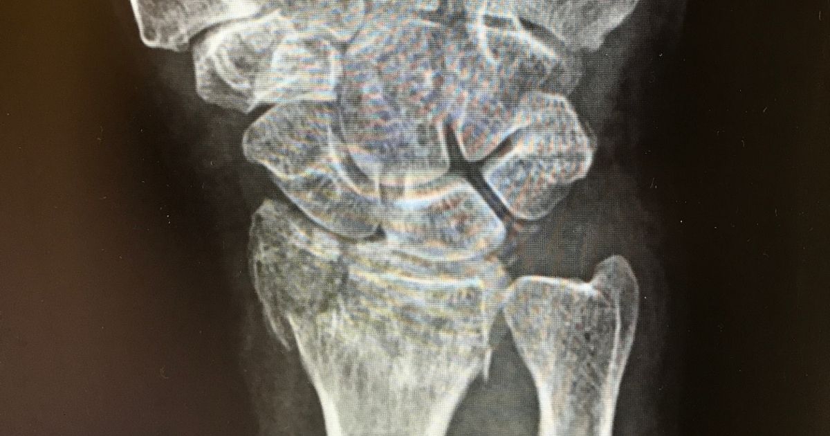 Distal radius fracture: Compound injury stabilised with Hoffman II External Fixator Surgical Technique - OrthOracle