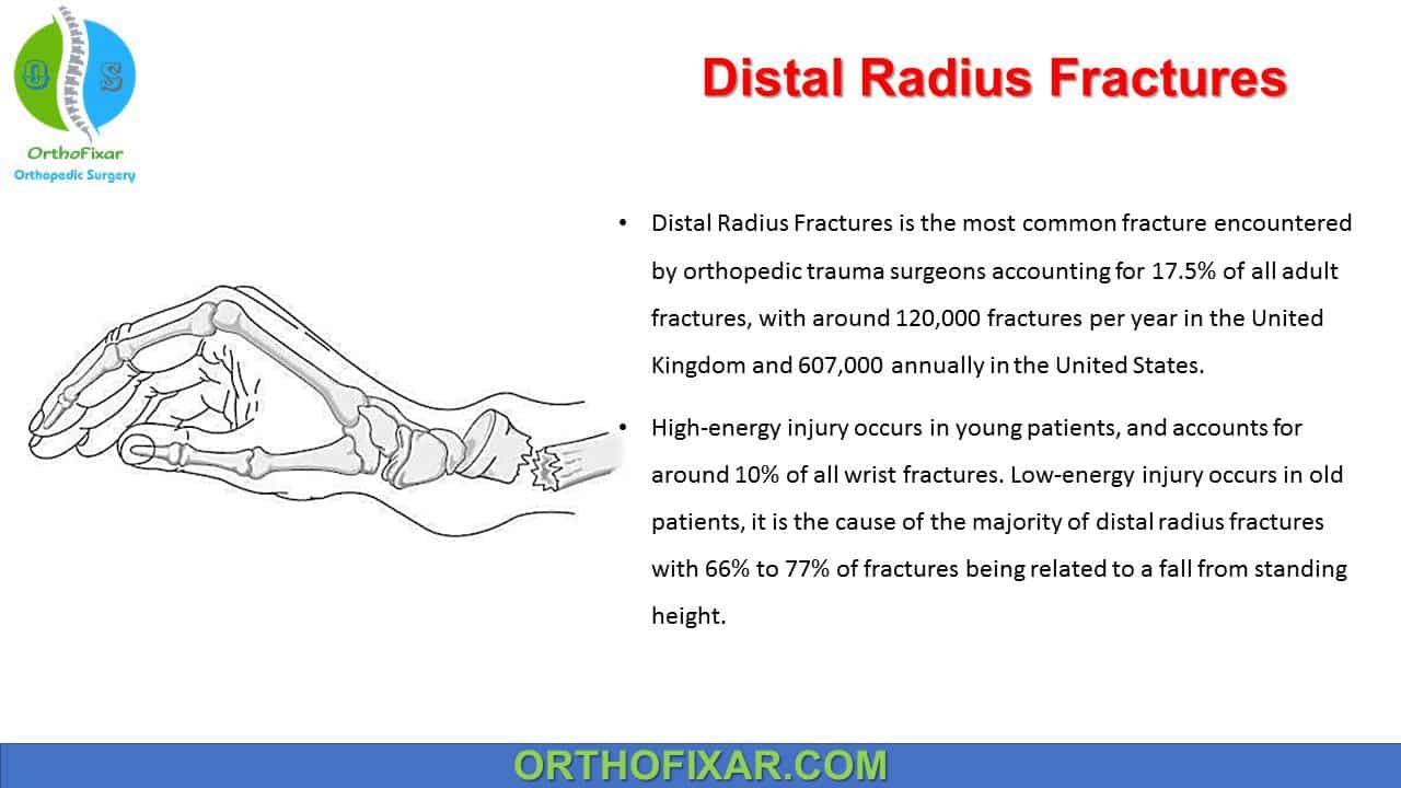 Distal radius fracture: Compound injury stabilised with Hoffman II <a href='/external-fix/'>External Fix</a>ator Surgical Technique - OrthOracle