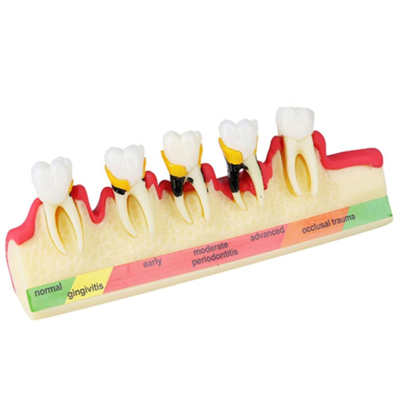 dental pathological periodontal disease model orthodontic medical instrument dental teaching teeth model