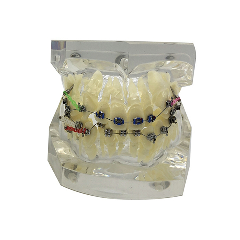 dental orthodontic model with clear gum orthodontic treatment model dental practice model with metal brackets