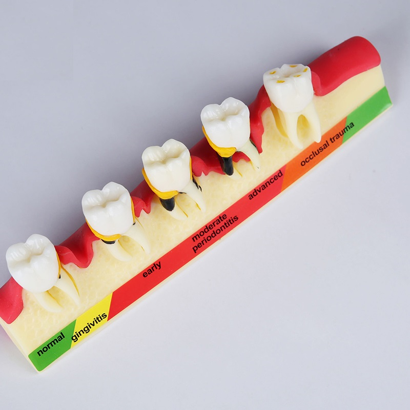 dental pathological periodontal disease model orthodontic medical instrument dental teaching teeth model