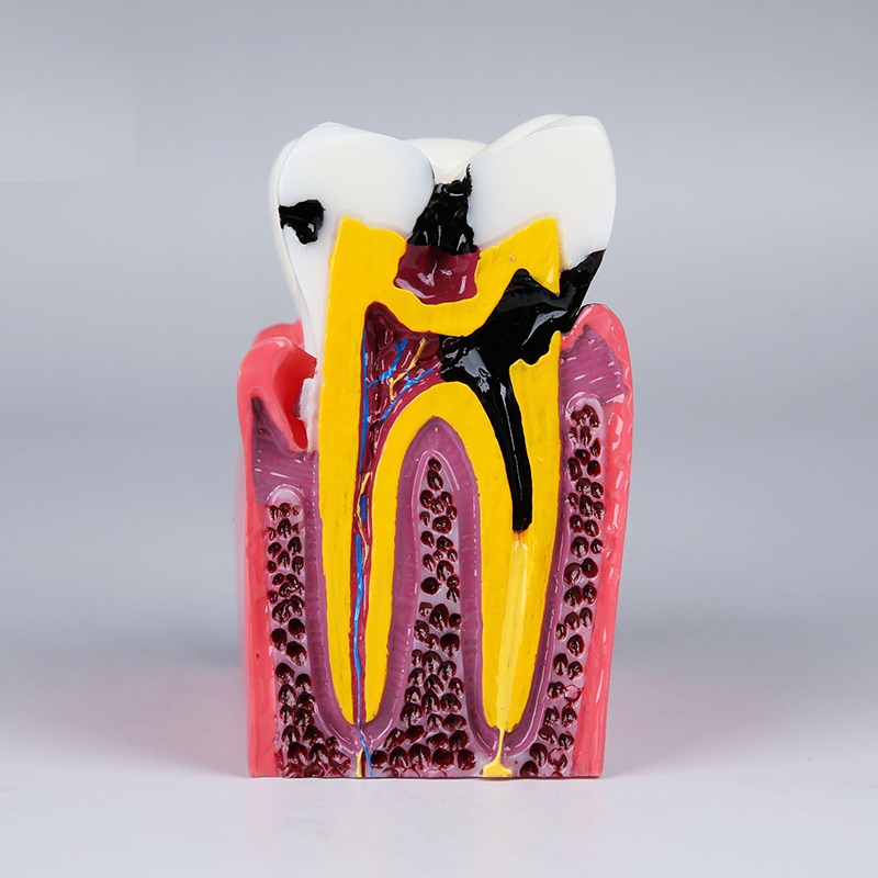 dental training caries model compares the healthy and caries tooth orthodontic dental practice teaching model