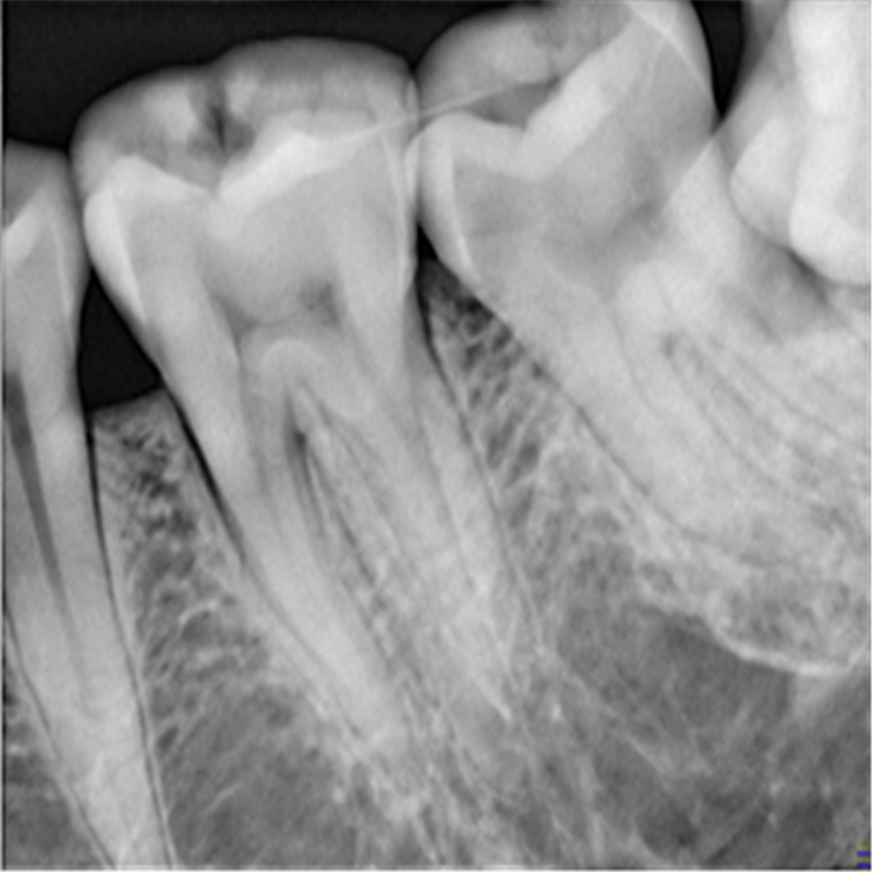 dental intraoral HDR 600 digital x-ray sensor RVG dental xray sensor size 2 advanceguard hdr sensor