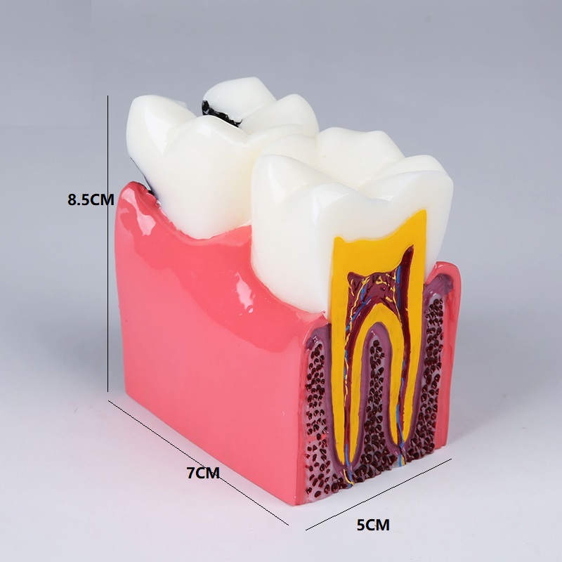 Dental orthodontic teeth model for dental study M 4021 caries model compare the healthy and caries tooth