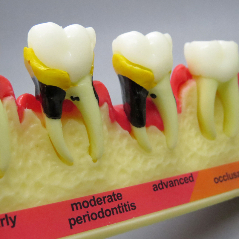 dental pathological periodontal disease model orthodontic medical instrument dental teaching teeth model