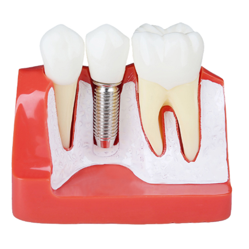 4 times dental single implant analysis model M2017R explain the single implant and bridge dental training model