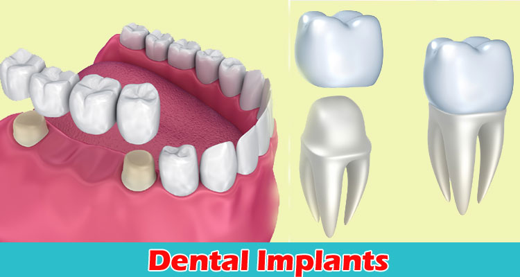 20:1 Mont Blanc Dental Implant Handpiece (762)