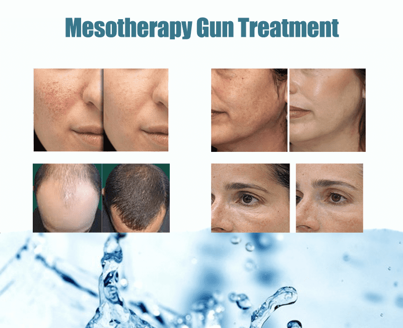 mesotherapy-before-and-after