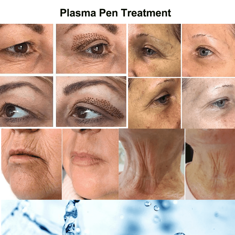 plasma-pen-treatment