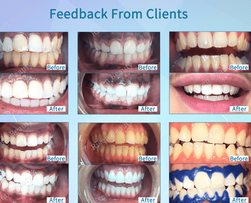 teeth-whitening-feedback