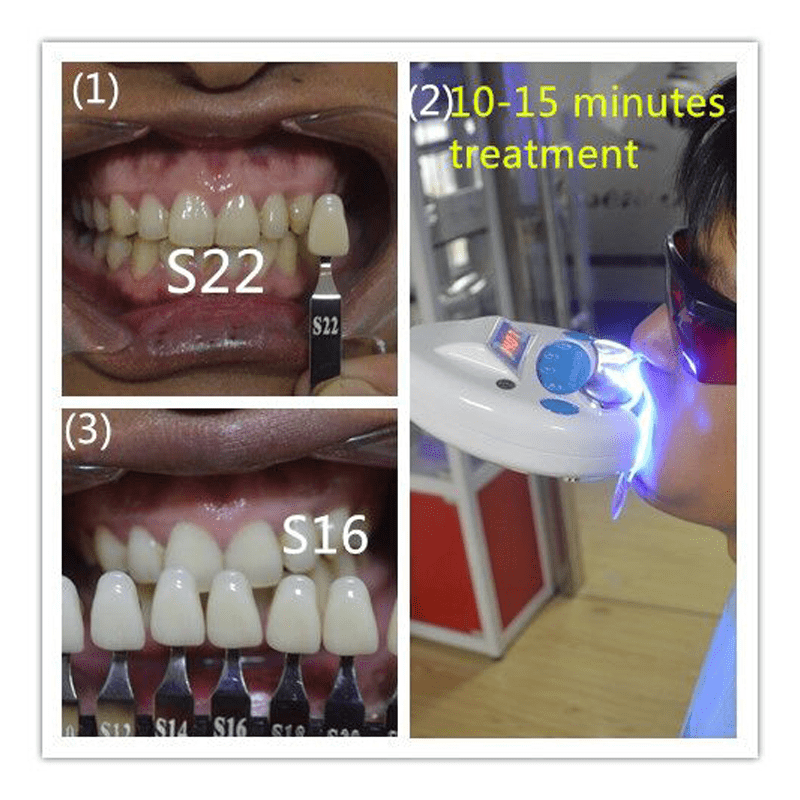 teeth-whitening-machine-with-case-03