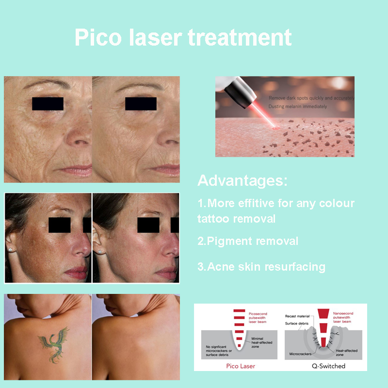pico-laser-tattoo-removal-machine-02