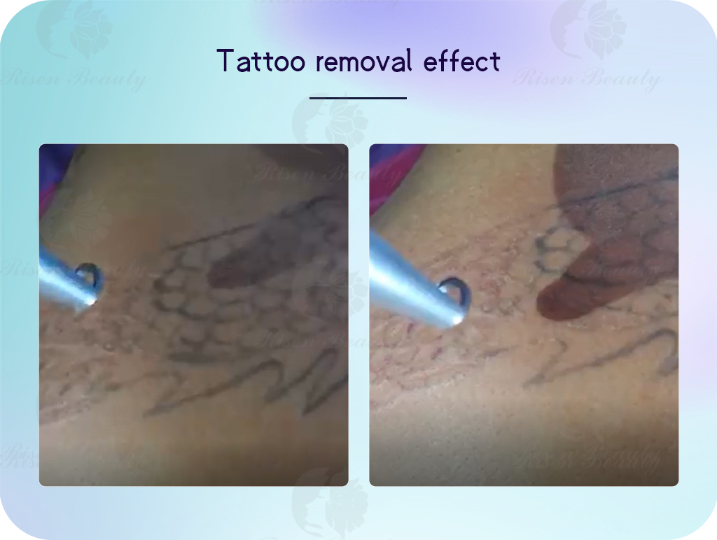 tattoo-removal-effect