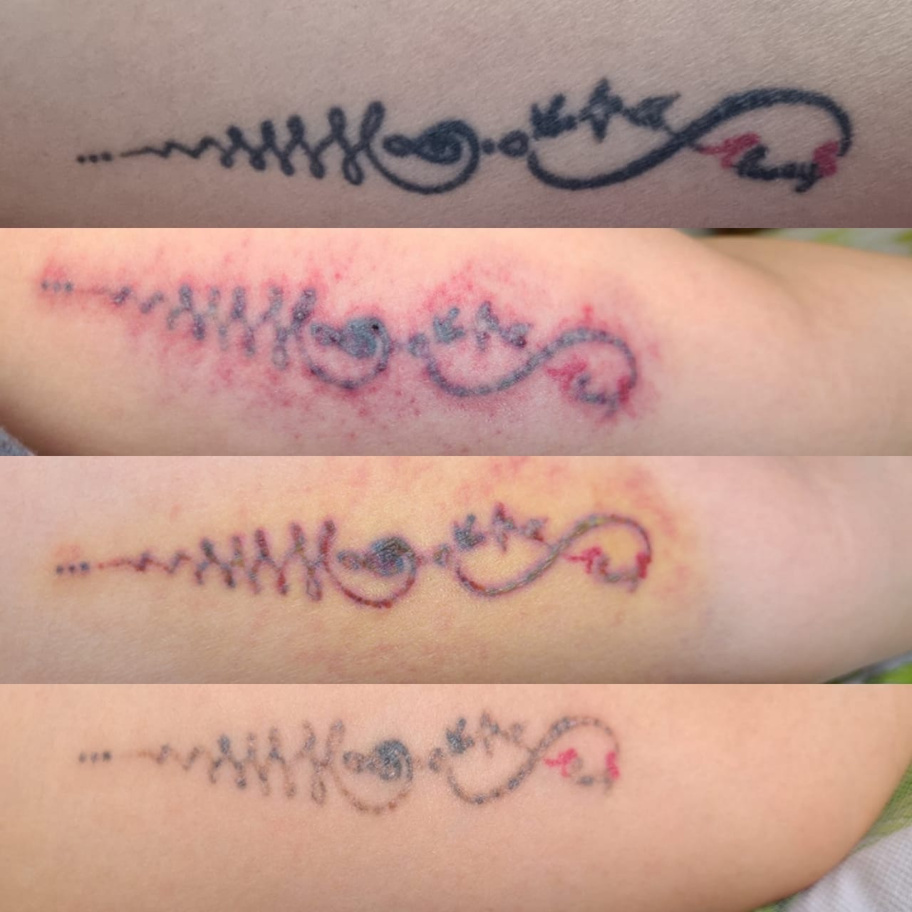 Laser Tattoo Removal Clinic Henley Beach