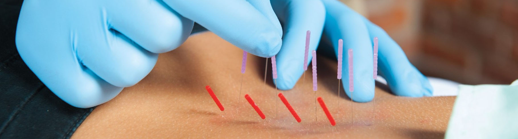 Flawless Fractional Needling Therapy: 1st Session