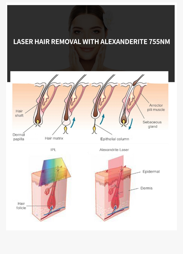 alex laser hair removal machine