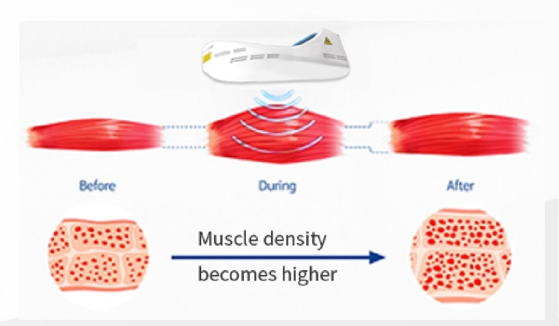 ems sculpting working principle