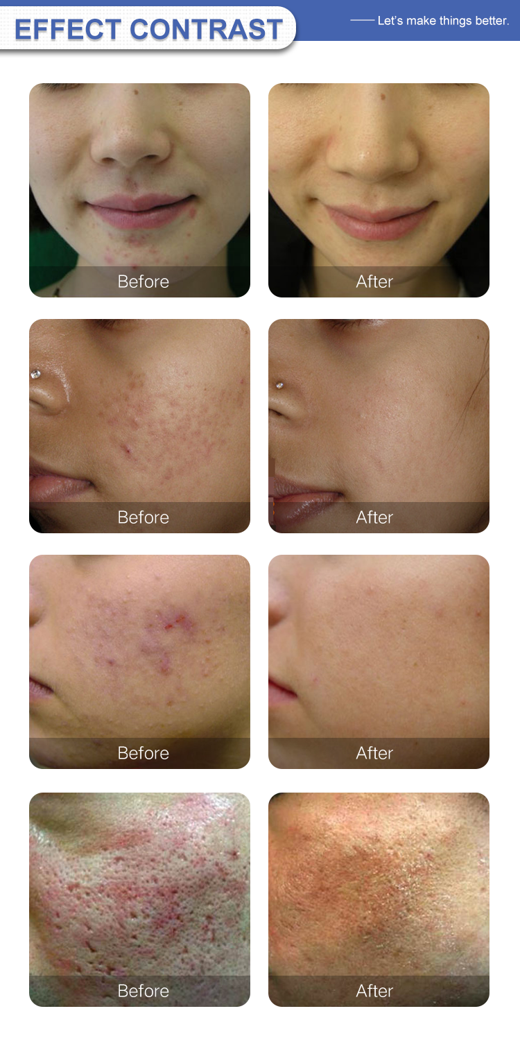 Microneedling Anti Aging machine effect