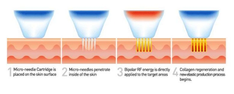 Microneedling Anti Aging machine working principle