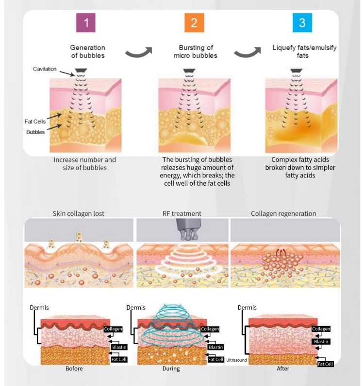 cavitation rf slimming3