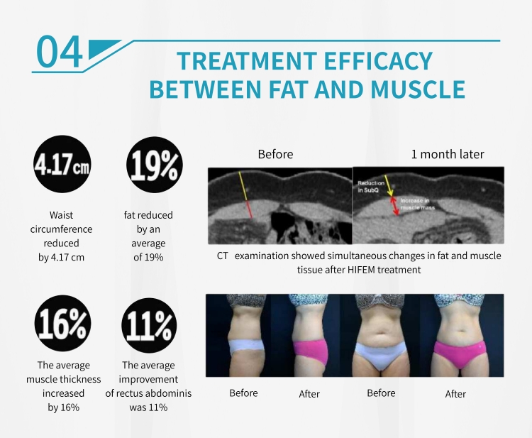 emsculpt machine8