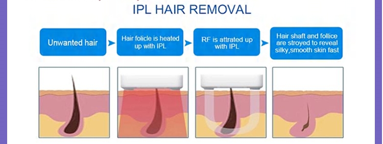 ipl hair removal