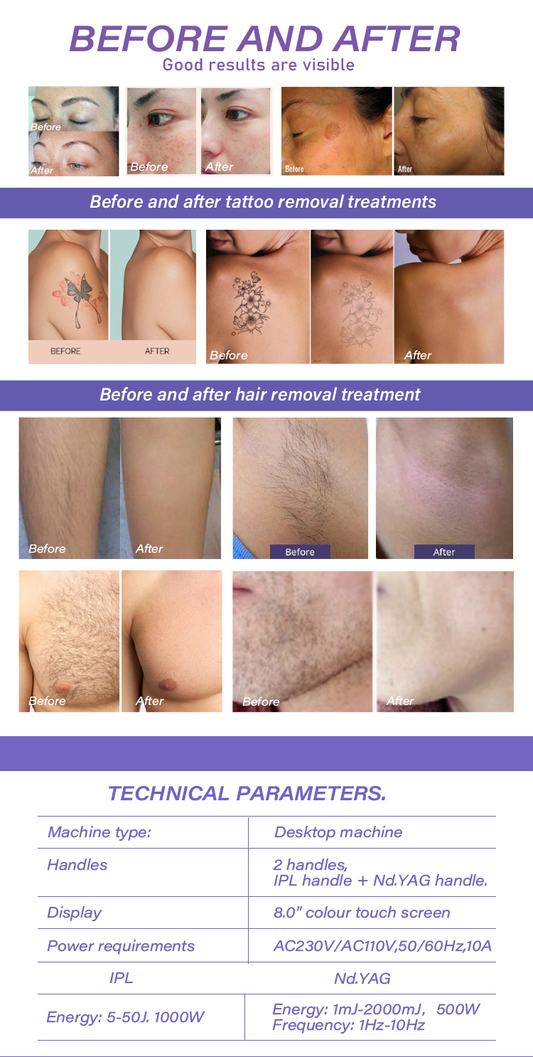 hair removal before and after