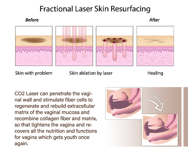 Co2 Laser Resurfacing Machine working principle