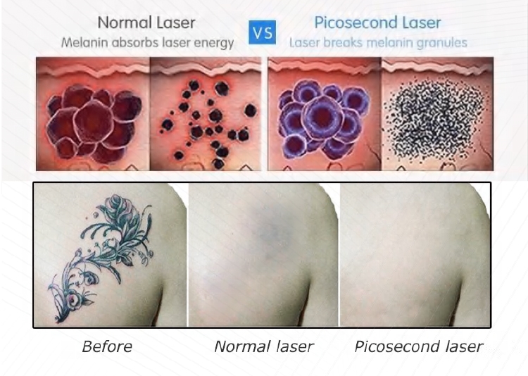 Picosecond Laser Machine principle