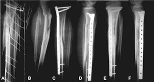 Lower Limbs Fracture Fixation Instrument Kit-(Big Kit) - Toptreemed Group