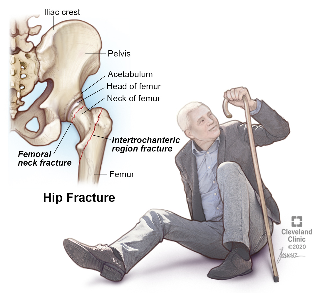 Hip fracture surgery - <a href='/intramedullary-nail/'>Intramedullary nail</a> insertion