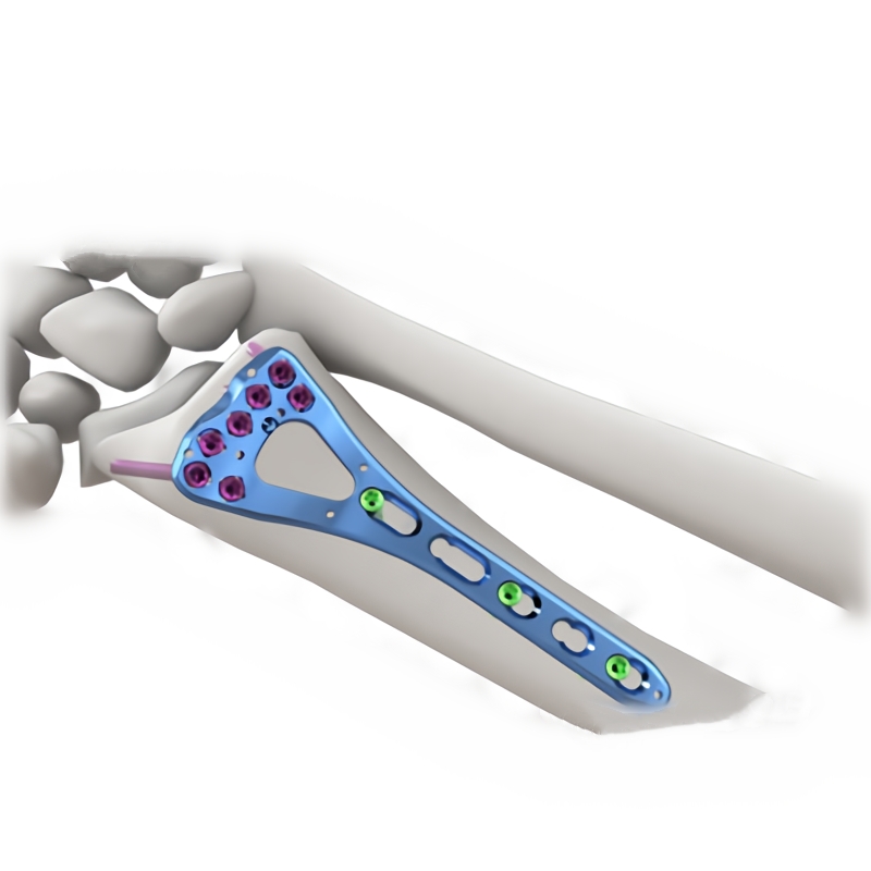 Distal Radius Medial <a href='/locking-plate/'>Locking Plate</a>s Ι