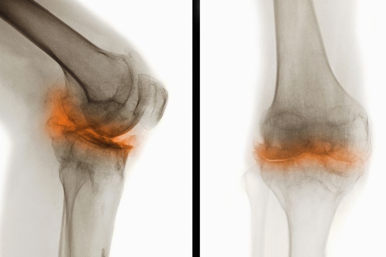 Bridging external fixator (temporary) for Complete articular fracture, simple articular, multifragmentary metaphyseal