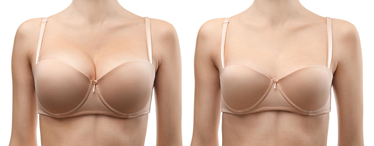 Breast implants? - Plastic Surgery Hub