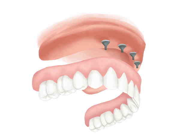 A Complete Breakdown of Dental Implant Costs (UK) | Gentle Dental