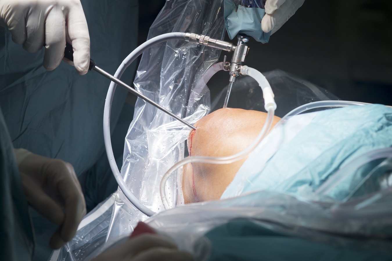 Arthroscopic knee surgery | Washington State Health Care Authority