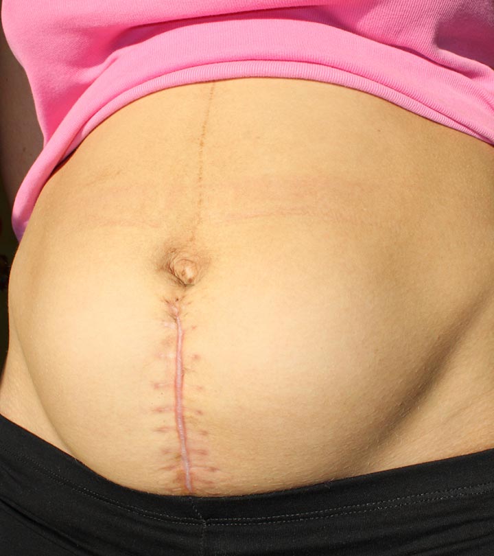 Cystoscopy (Bladder Scope): Purpose, Procedure, Side Effects, Risks