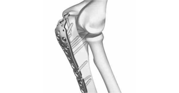 JMS - Large Fragment <a href='/locking-plate/'>Locking Plate</a>s