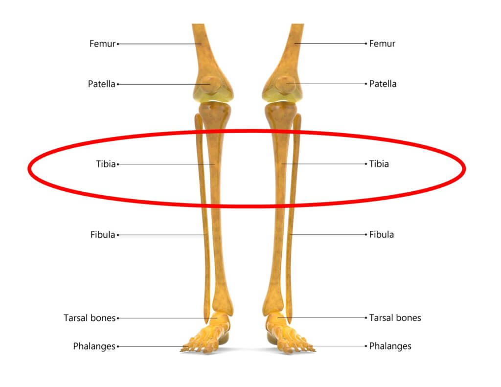 Tibial plateau fracture - Tibial Plateau Fracture