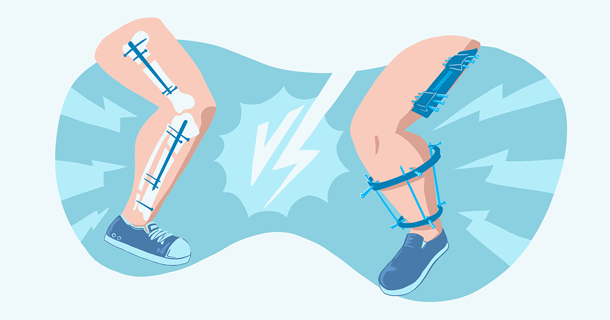 External fixation for Extraarticular, simple, transverse