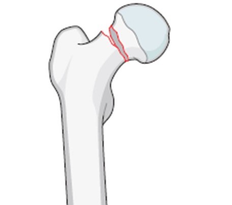 Femur Fracture Fixation (Stryker Gamma Nail) - Orthopaedic Associates of Riverside